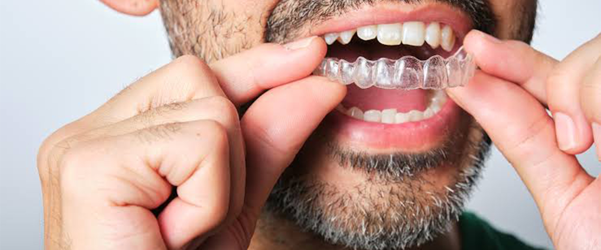 Aligners Dentist In Sion