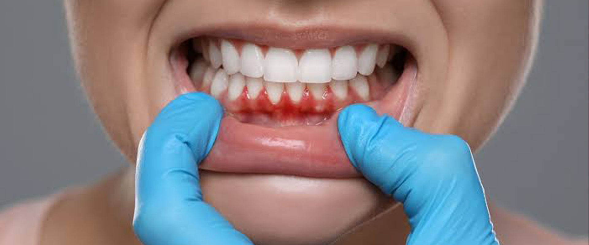 Gums Treatment In Sion