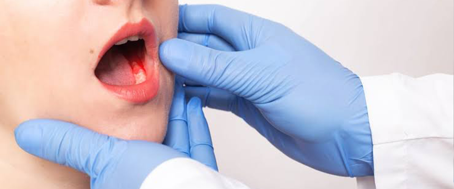 Oral Cancer Doctor In Sion