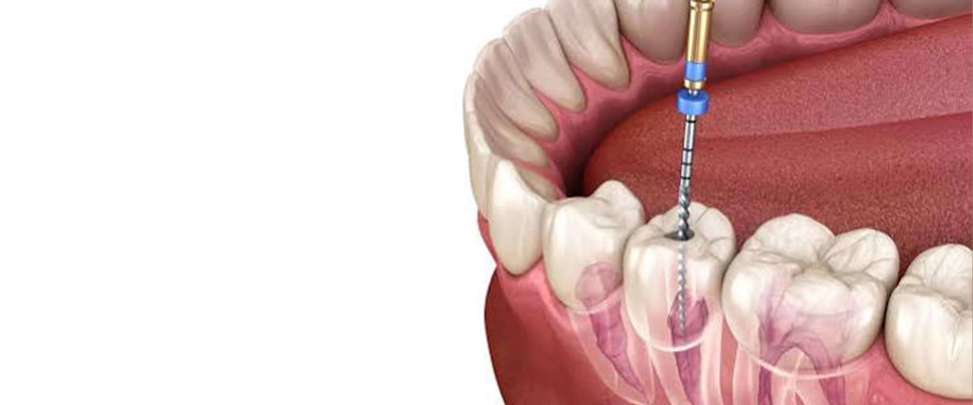 Root Canal Specialist Near Sion