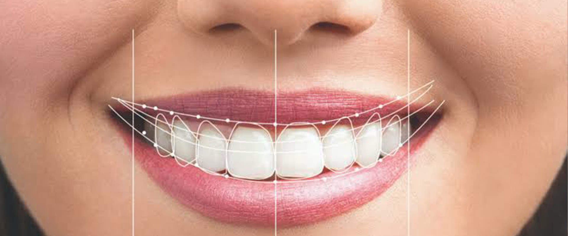 Smile Designing In Sion