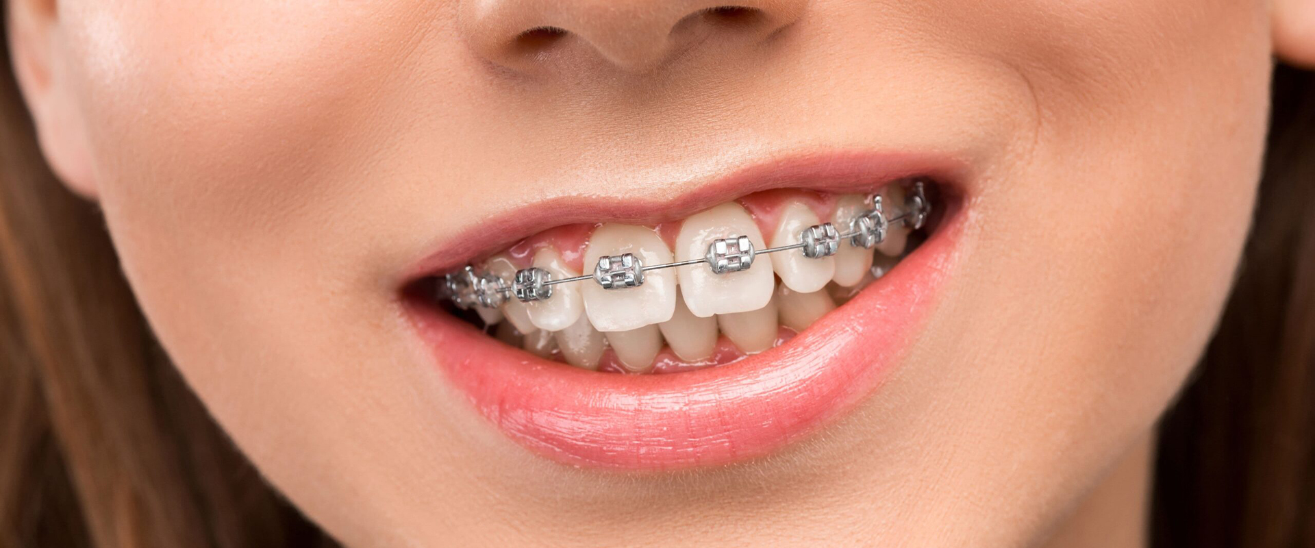 Braces Dentist In Sion