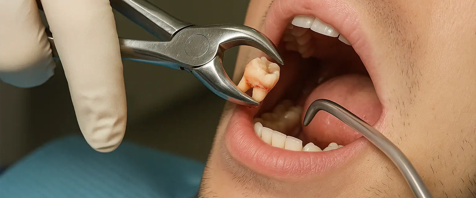 Wisdom Tooth Treatment In Sion