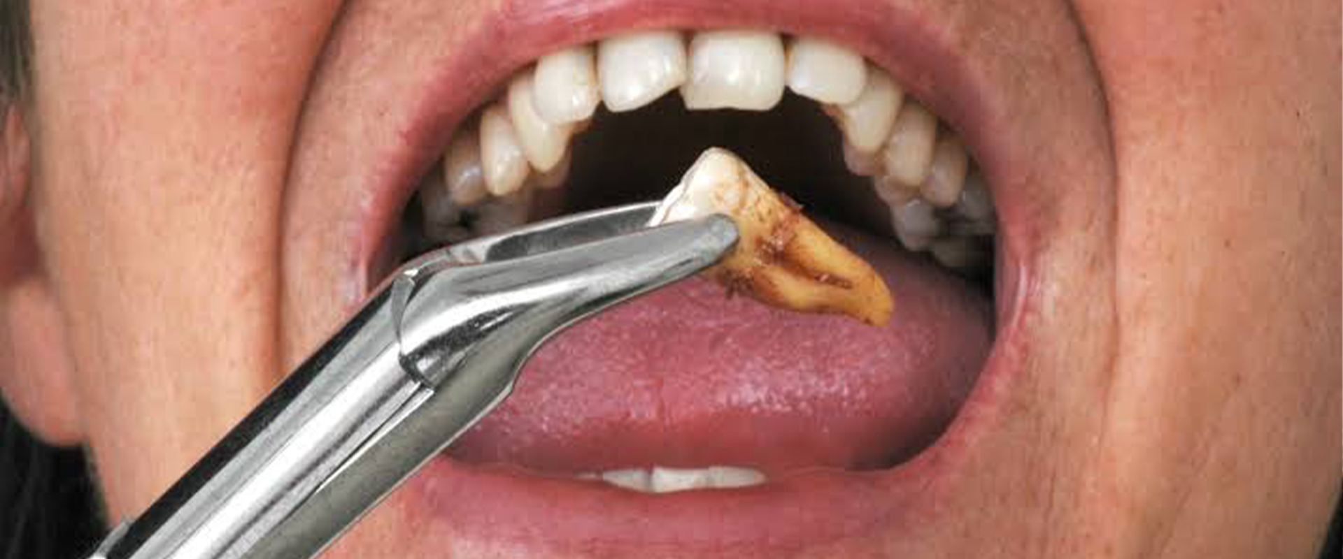 Dental Extraction In Sion