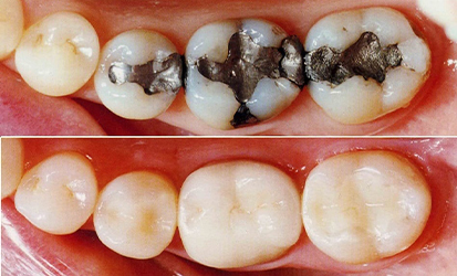 Tooth-Colored Fillings