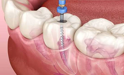 Root Canal Treatment (RCT)