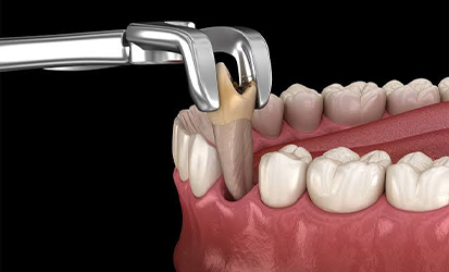Wisdom Tooth Extractions