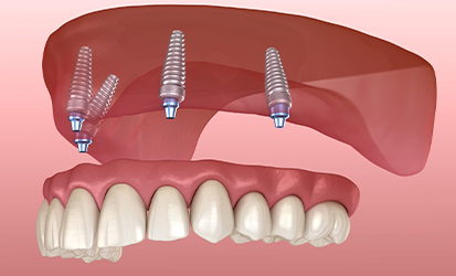 Dentures & Implants