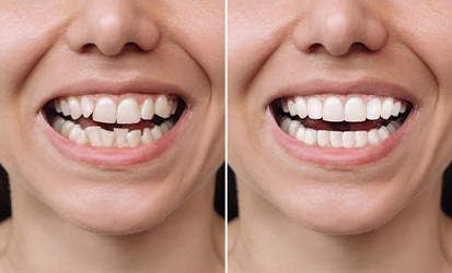 Veneers