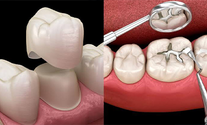 Tooth-Colored Fillings and Crowns