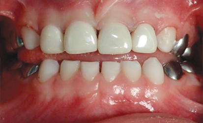 Stainless Steel and Esthetic Crowns
