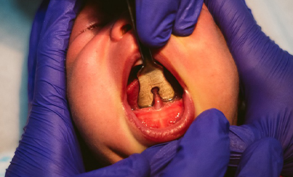 Tongue Tie and Lip Tie Laser Treatment
